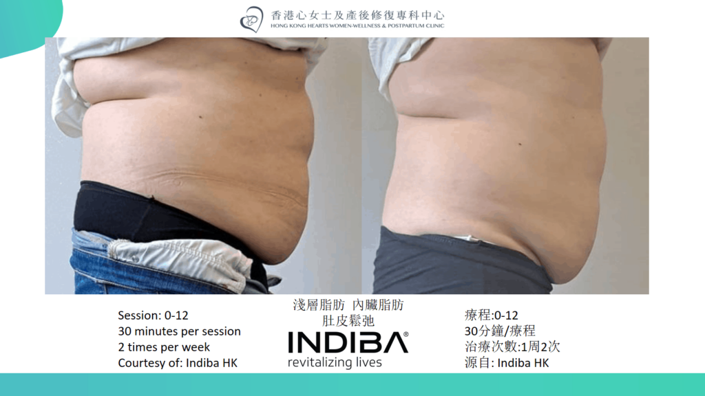 indiba Slide23.png