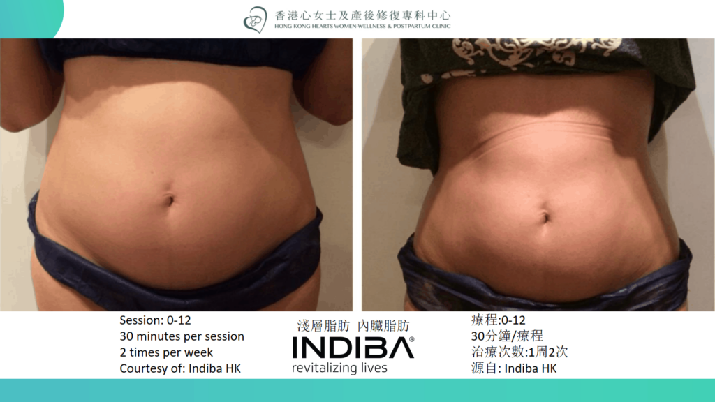 indiba Slide25.png