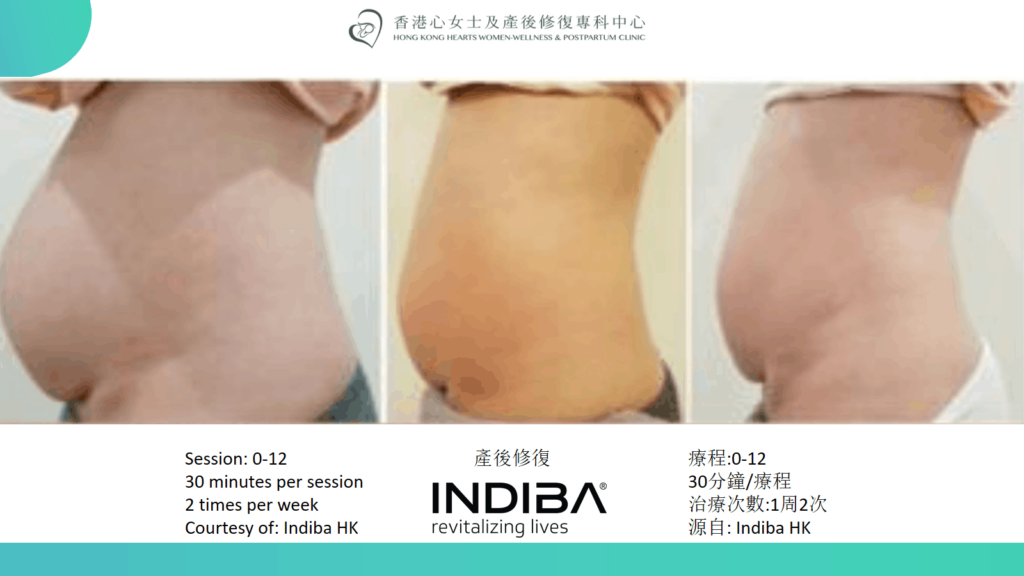 indiba Slide29.png