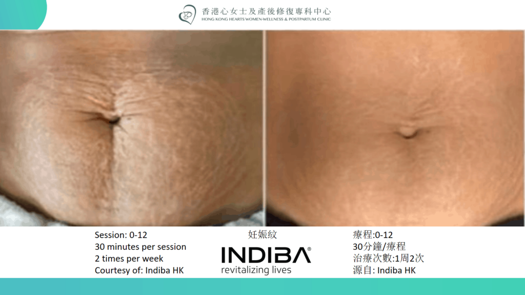 indiba Slide33.png