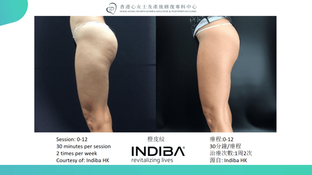 indiba Slide35.png