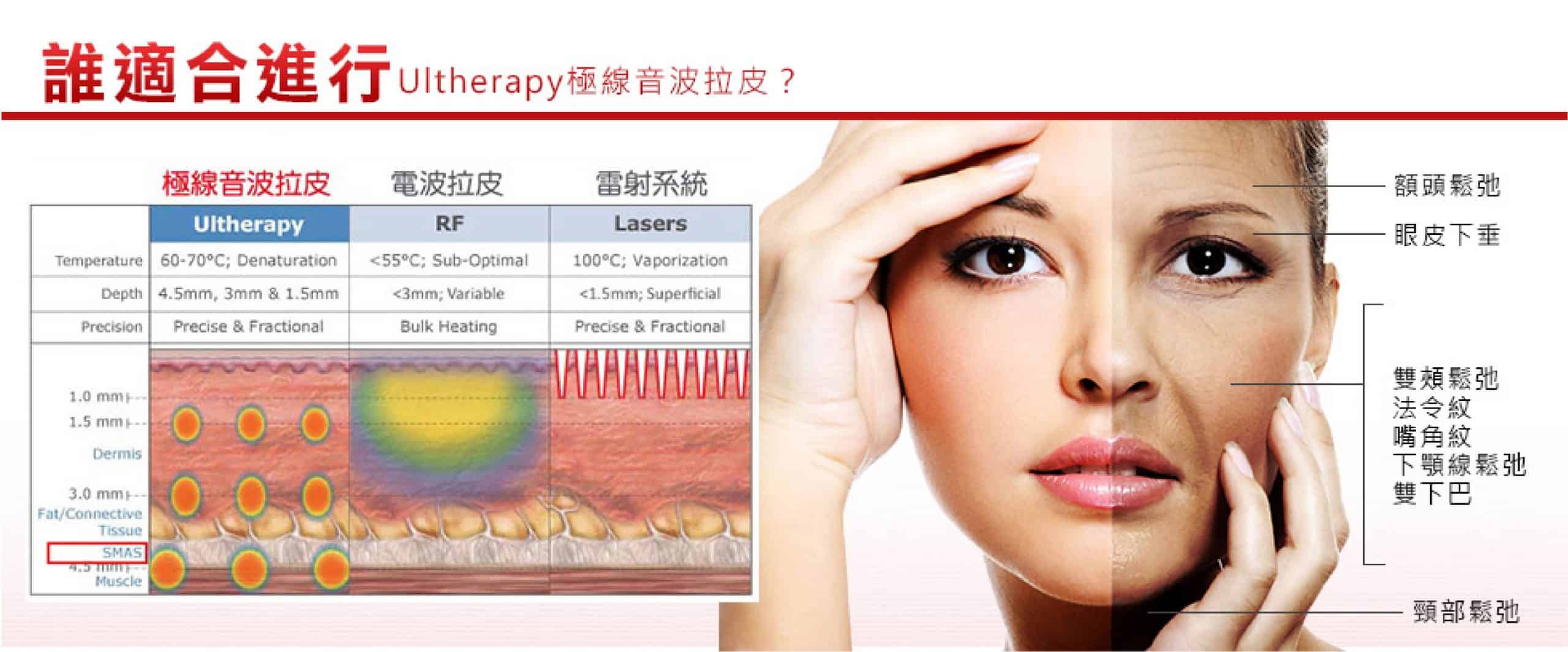 Ulthera高能量聚焦超聲刀 Ulthera高能量聚焦超聲刀