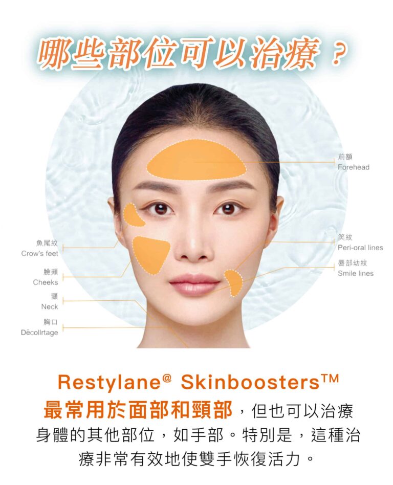 Restylane Restylane