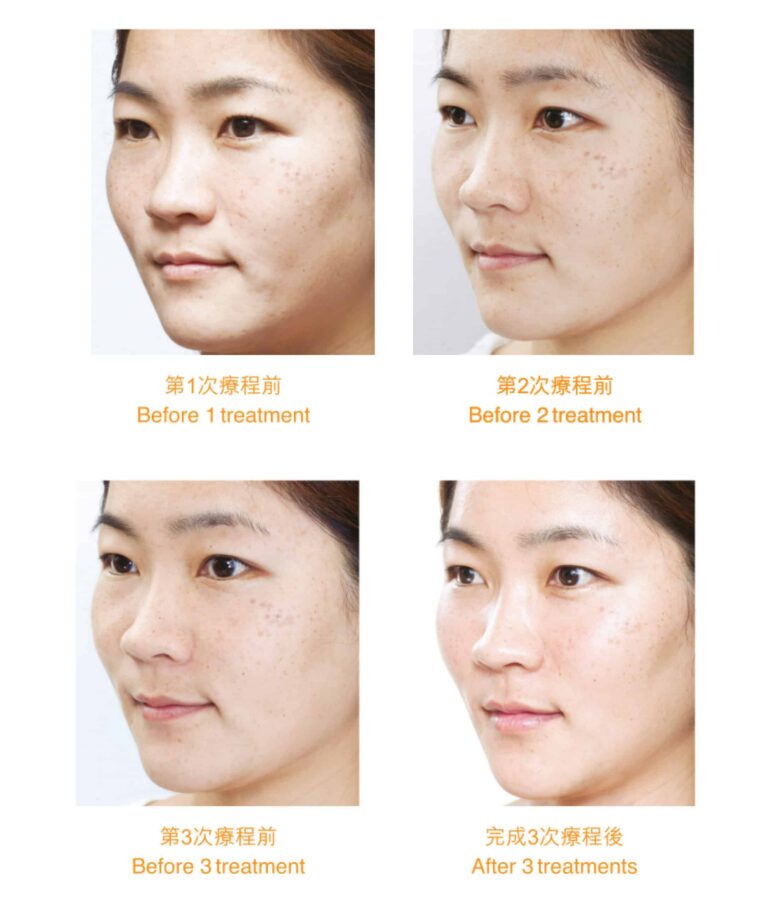Restylane Restylane