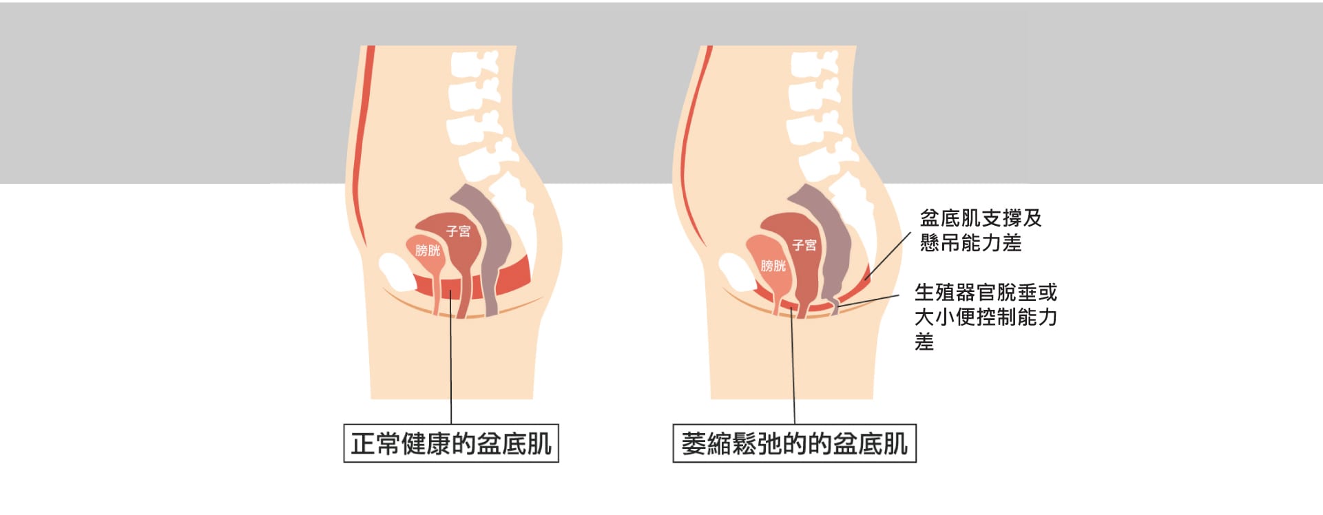 紮肚及產後修復療程優惠